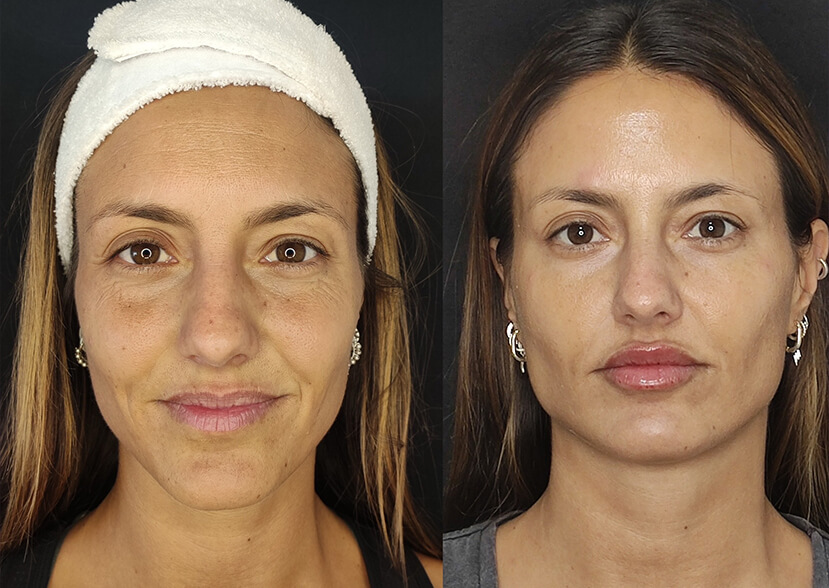 Tratamiento de armonización facial con ácido hialurónico y Toxina botulínica